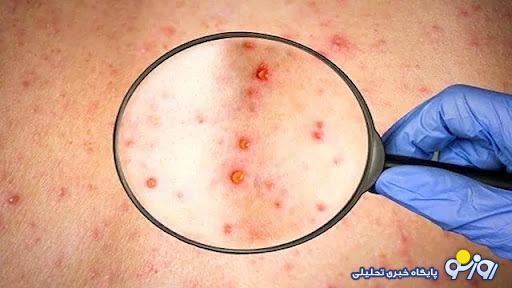 میزان کشندگی آبله میمون چقدر است؟ میزان کشندگی آبله میمون چقدر است؟